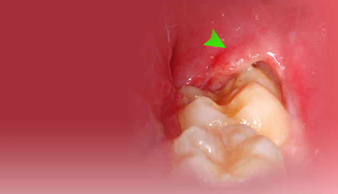 Oh! My aching wisdom teeth!