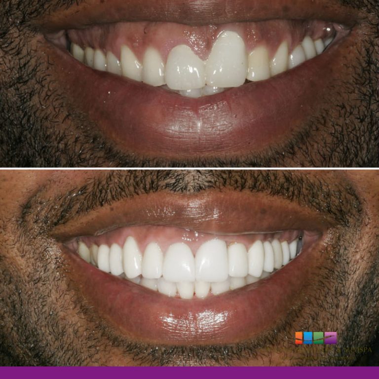 Atlanta GA Gummy Smile Correction Sandy Springs Gum Reshaping