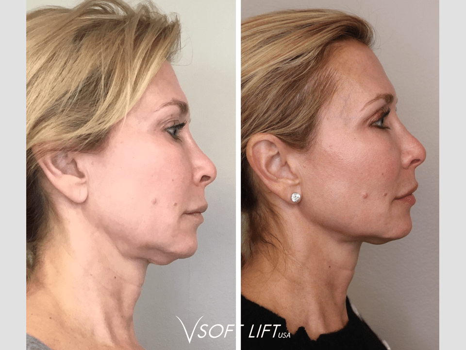 PDO Threads Lifts Atlanta, GA Smooth Thread Lift Near Me