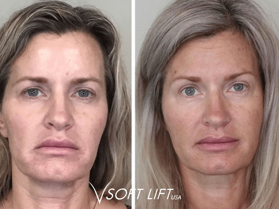 PDO Threads Lifts Atlanta, GA Smooth Thread Lift Near Me