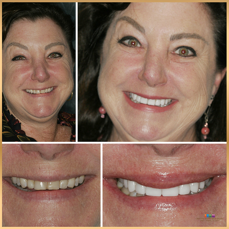 Dental Veneers in Covington, GA Improve the Appearance of Your Teeth