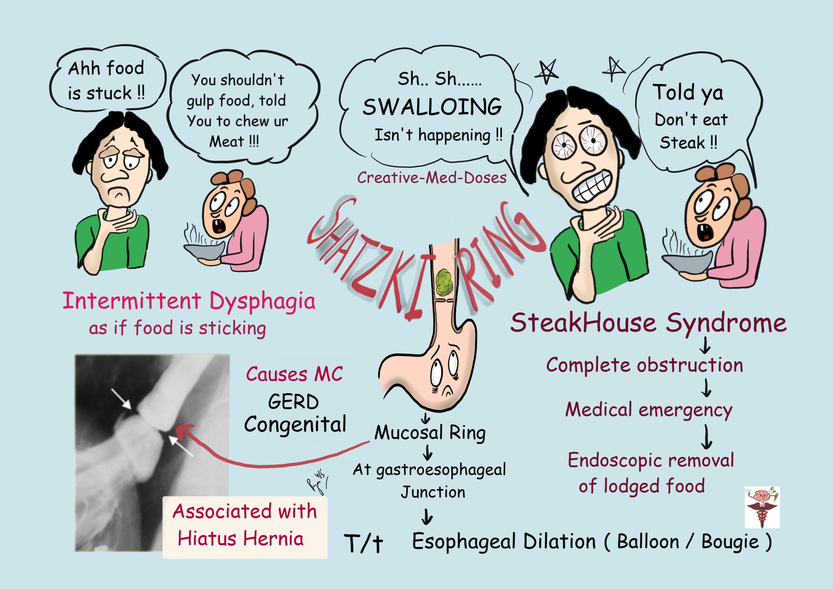 Schatzki Ring Creative Med Doses