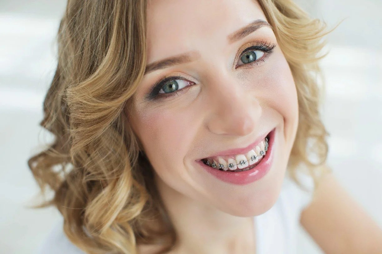 SelfLigating Braces vs Invisalign Which Is the Right Choice for Me
