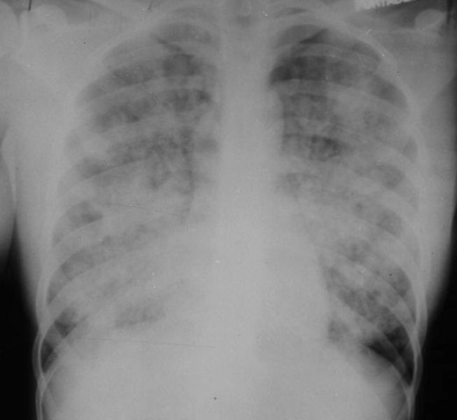 Acute respiratory distress syndrome