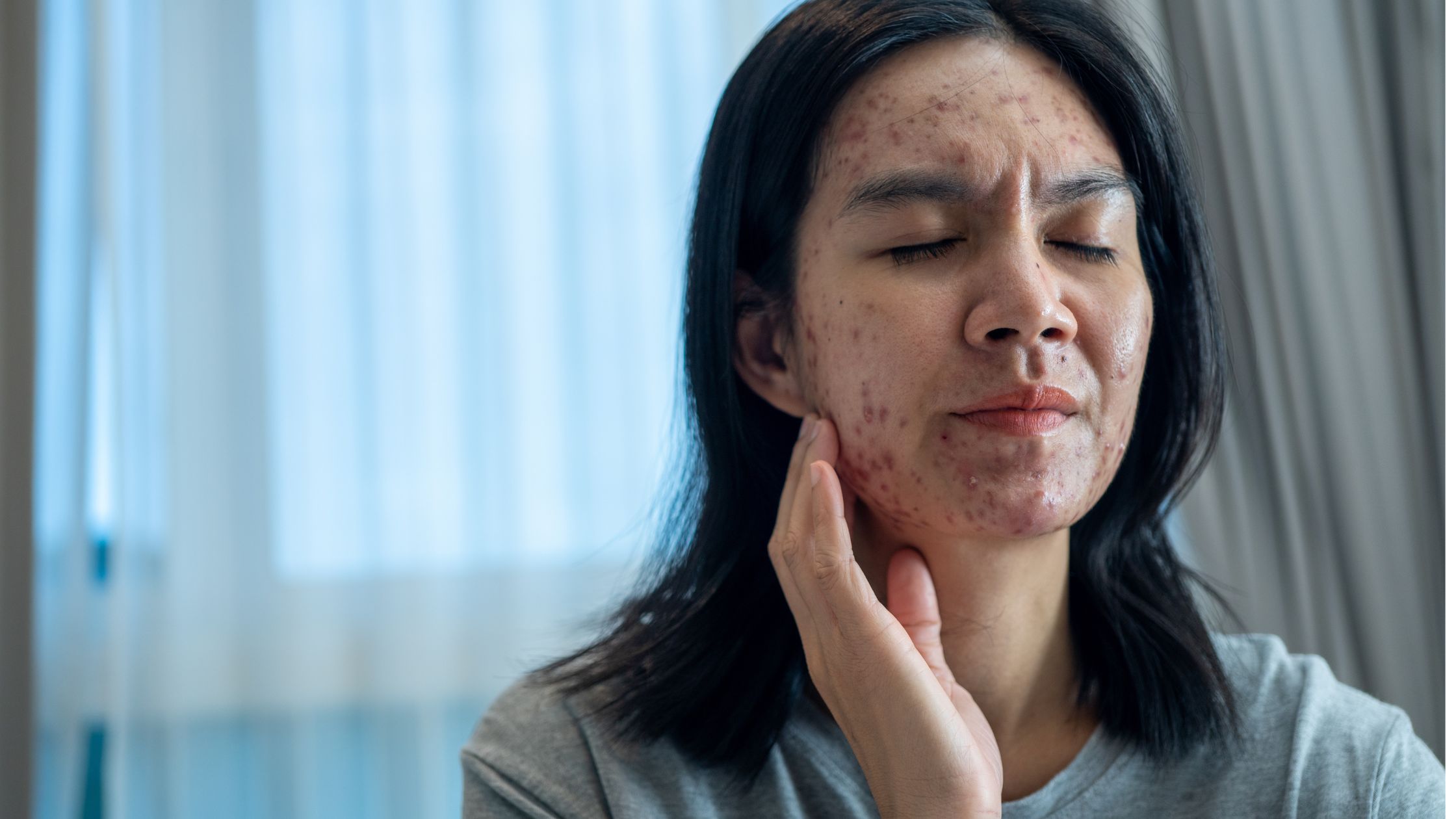 Board Certified Acne Dermatologist Eastern Shore Cronin Dermatology