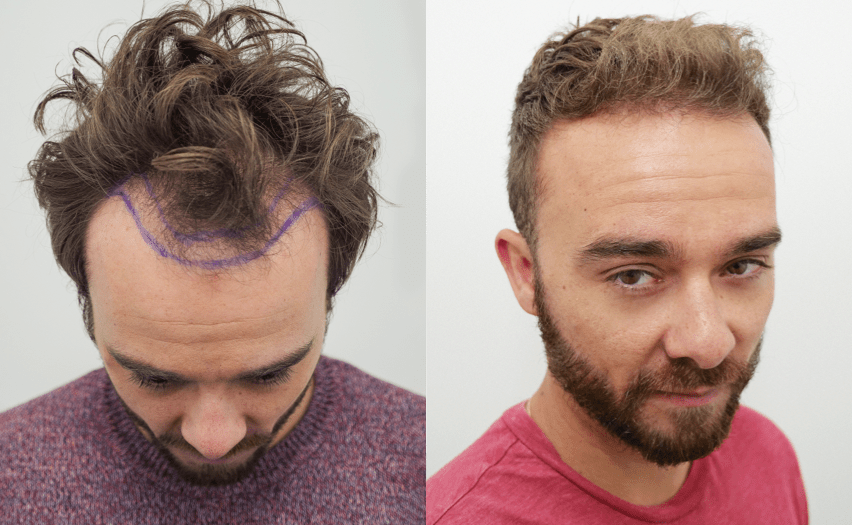The best hair transplant in Albania Results before and after! Is it
