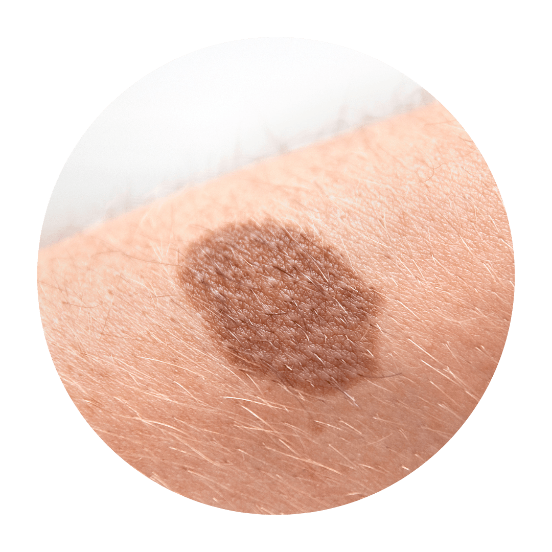 Solar lentigines (age and sun spots, liver spots) Cryopen