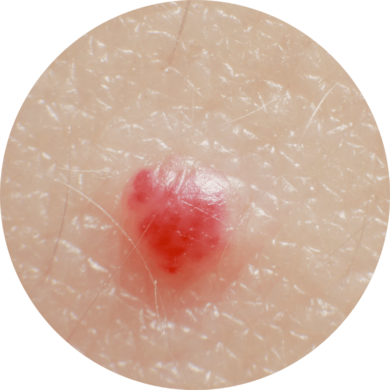 Cherry Angiomas Achieve Satisfaction with Cryotherapy