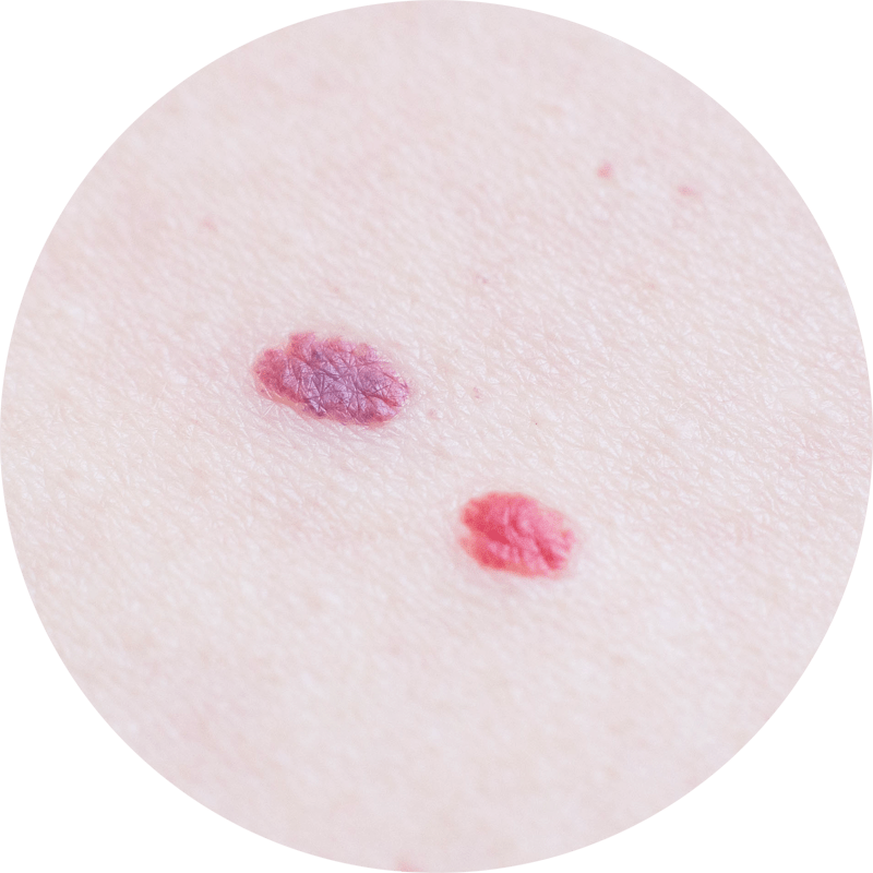 Cherry Angiomas Achieve Satisfaction with Cryotherapy