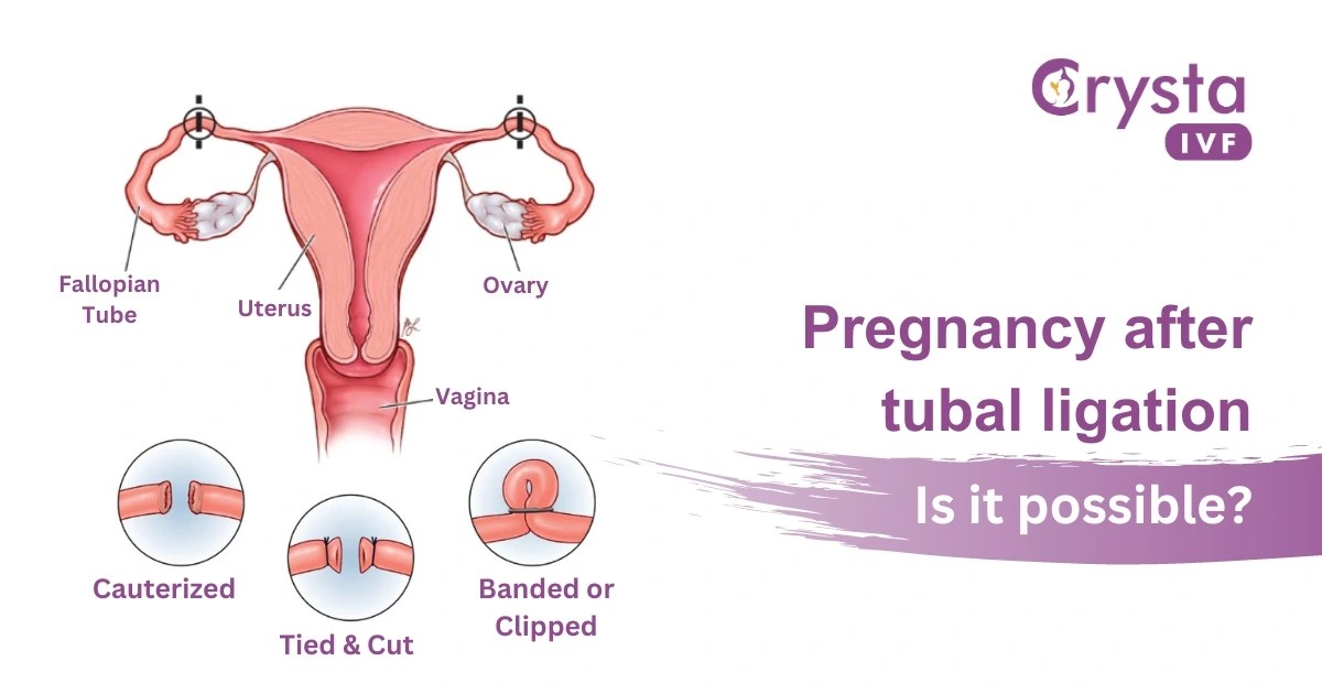 Can Pregnancy Occur After Tubal Ligation?