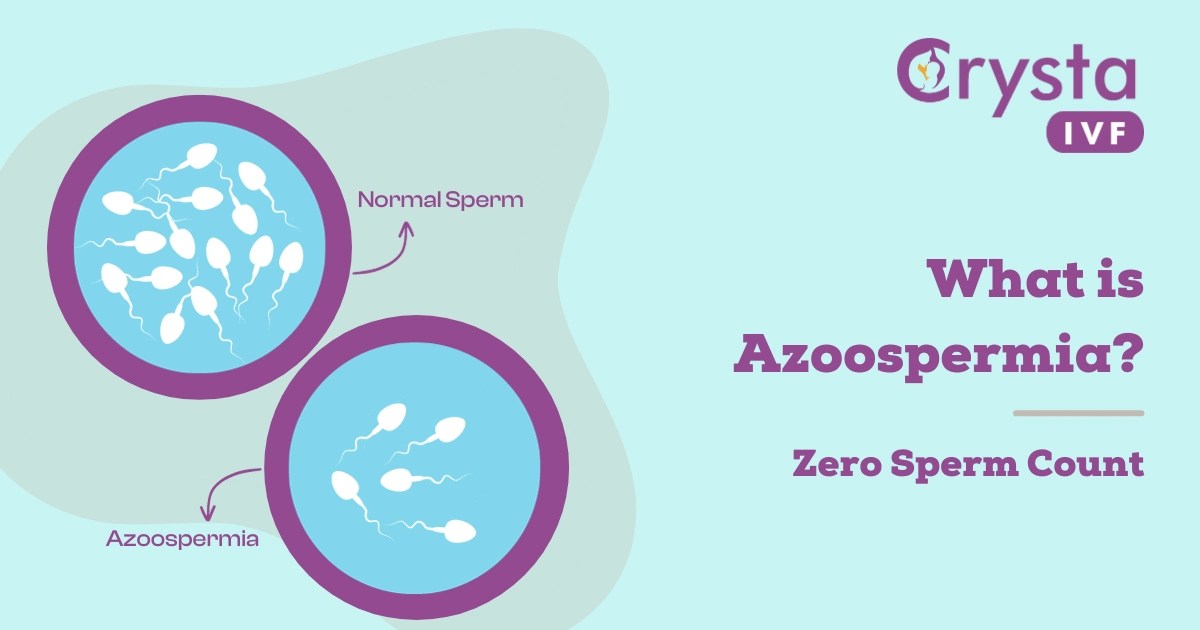 What is Azoospermia? Causes, Symptoms and Treatment