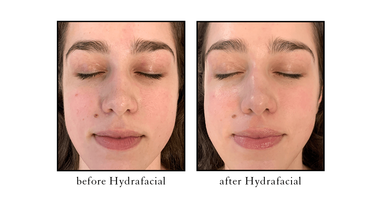 Hydrafacial MD Facials Cosmetic Skin & Laser Center