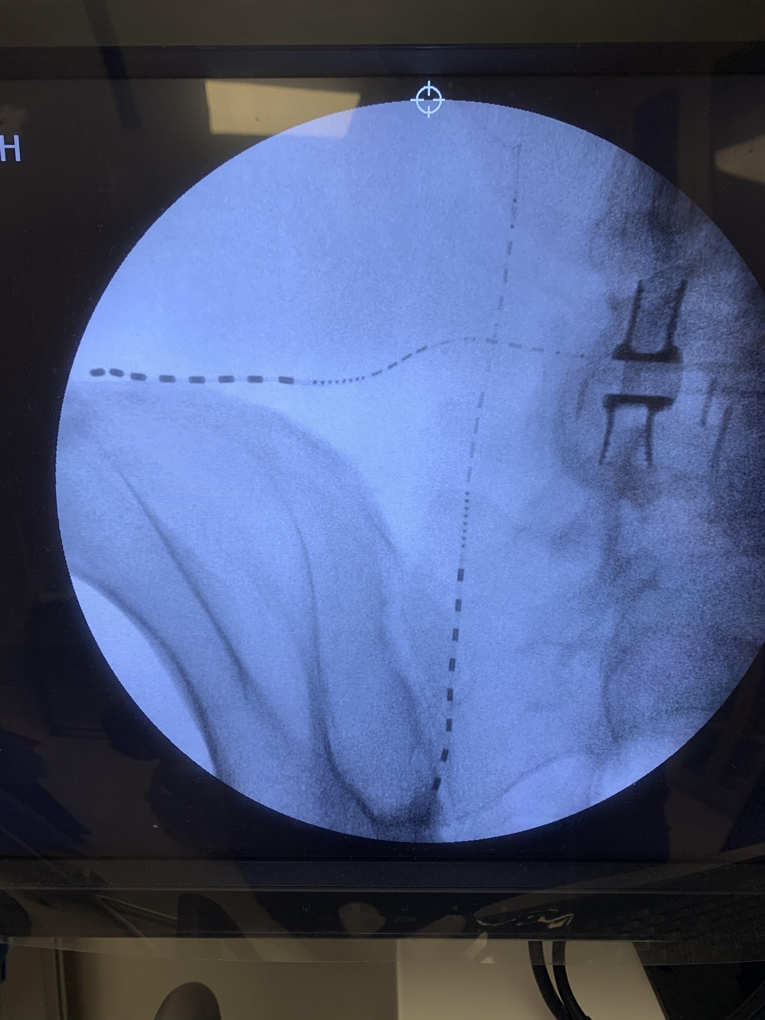 Raymond Tatevossian, MD, implants Stimwave for Buttock Pain