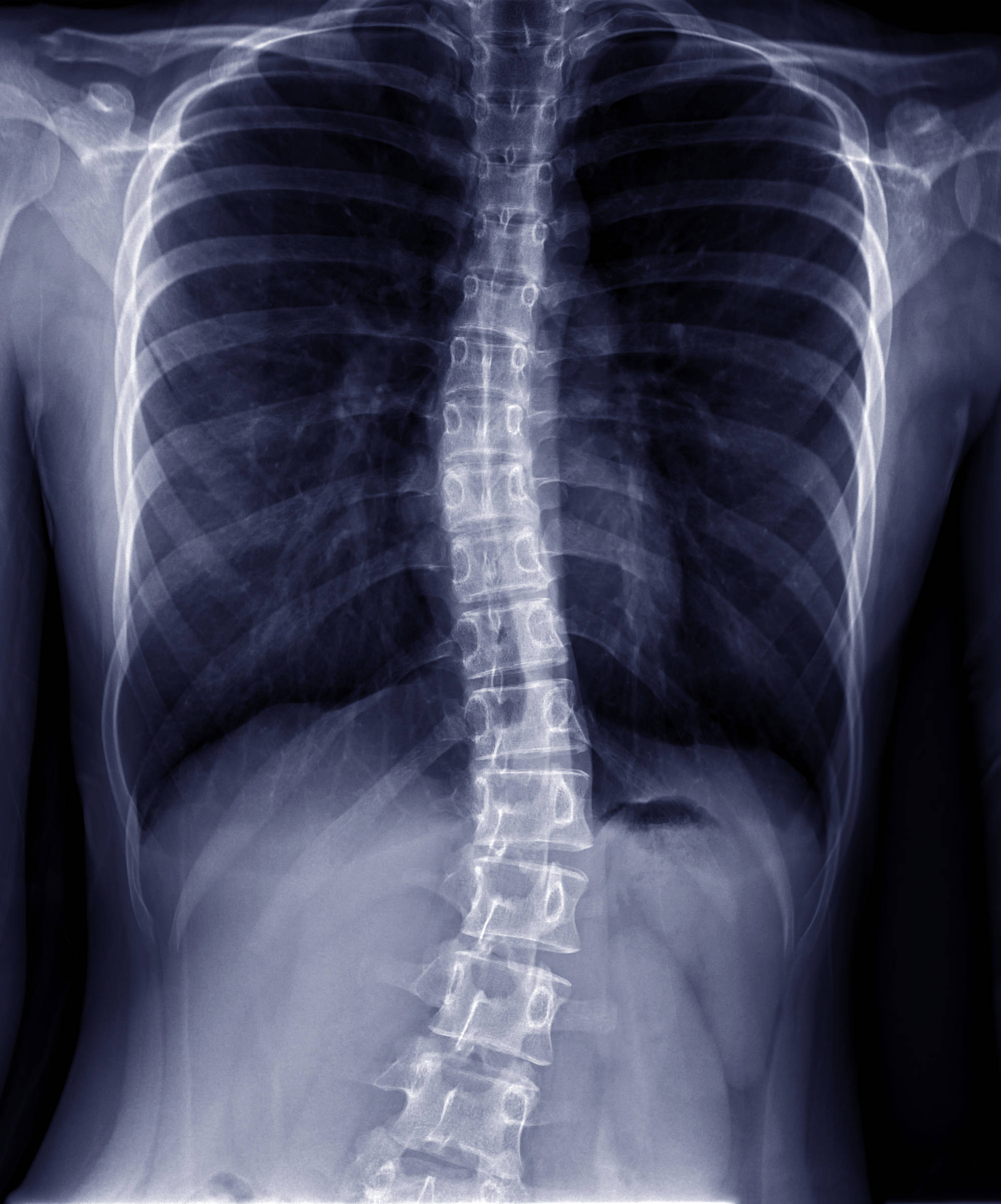 Anesthesia Considerations for Patients with Scoliosis Connecticut