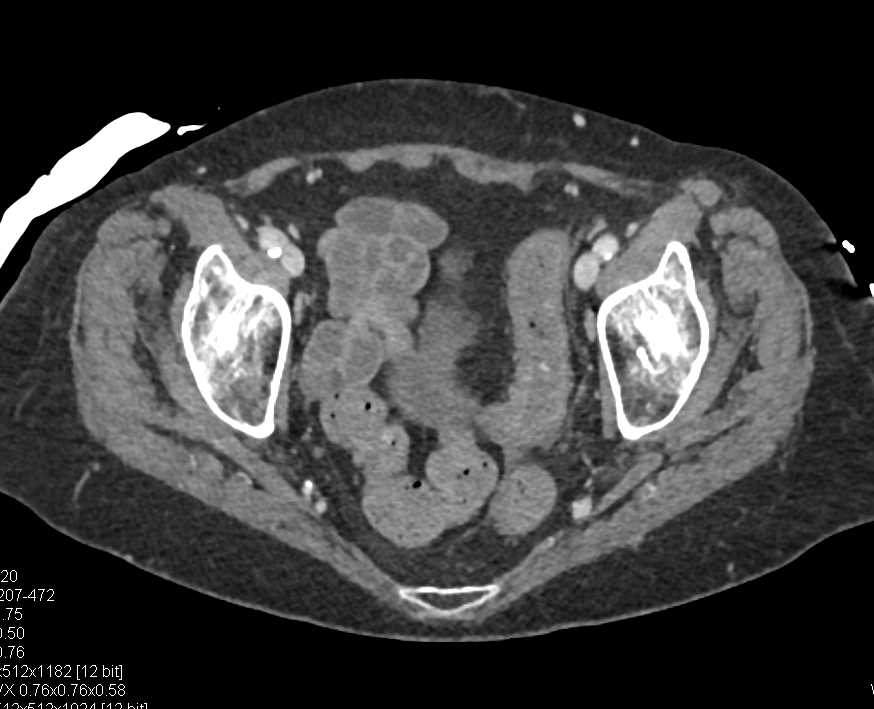 Ulcerative Colitis Colon Case Studies CTisus CT Scanning