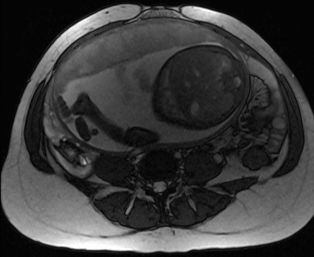 Normal Placenta Body MR Case Studies CTisus CT Scanning