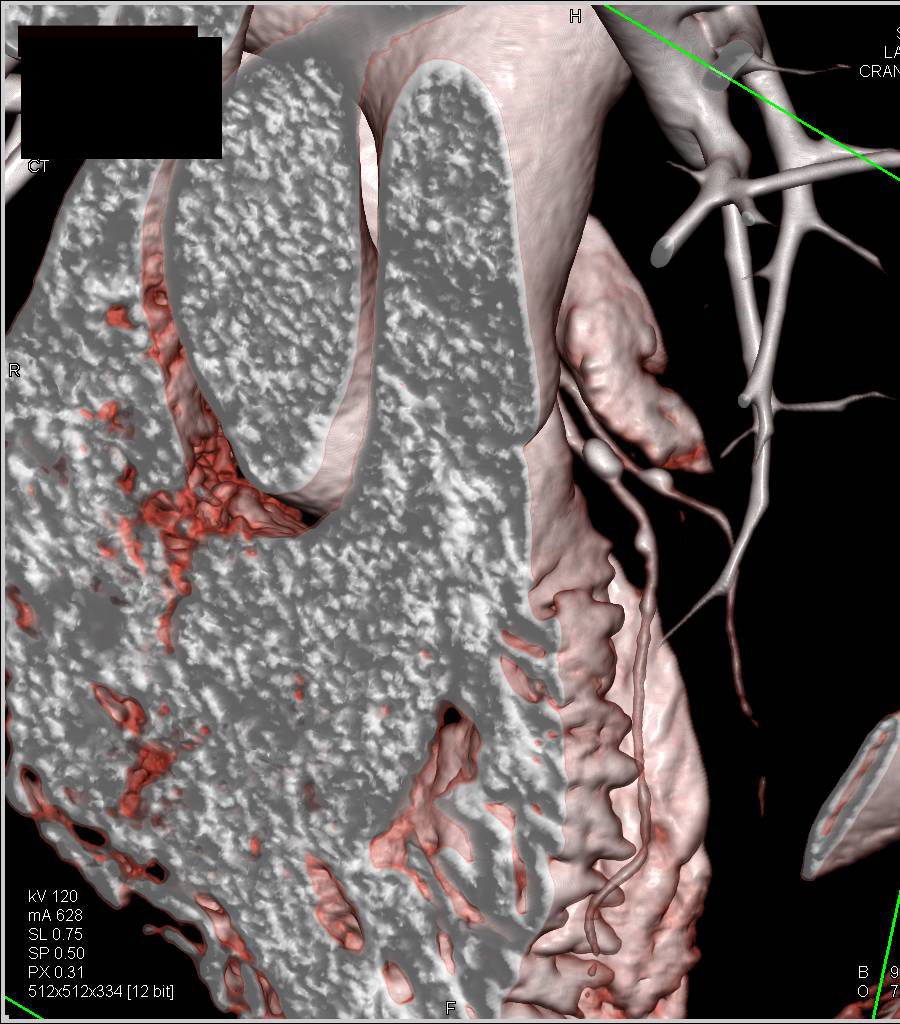 CCTA Coronary Artery Disease with Calcified Plaques on All Vessels
