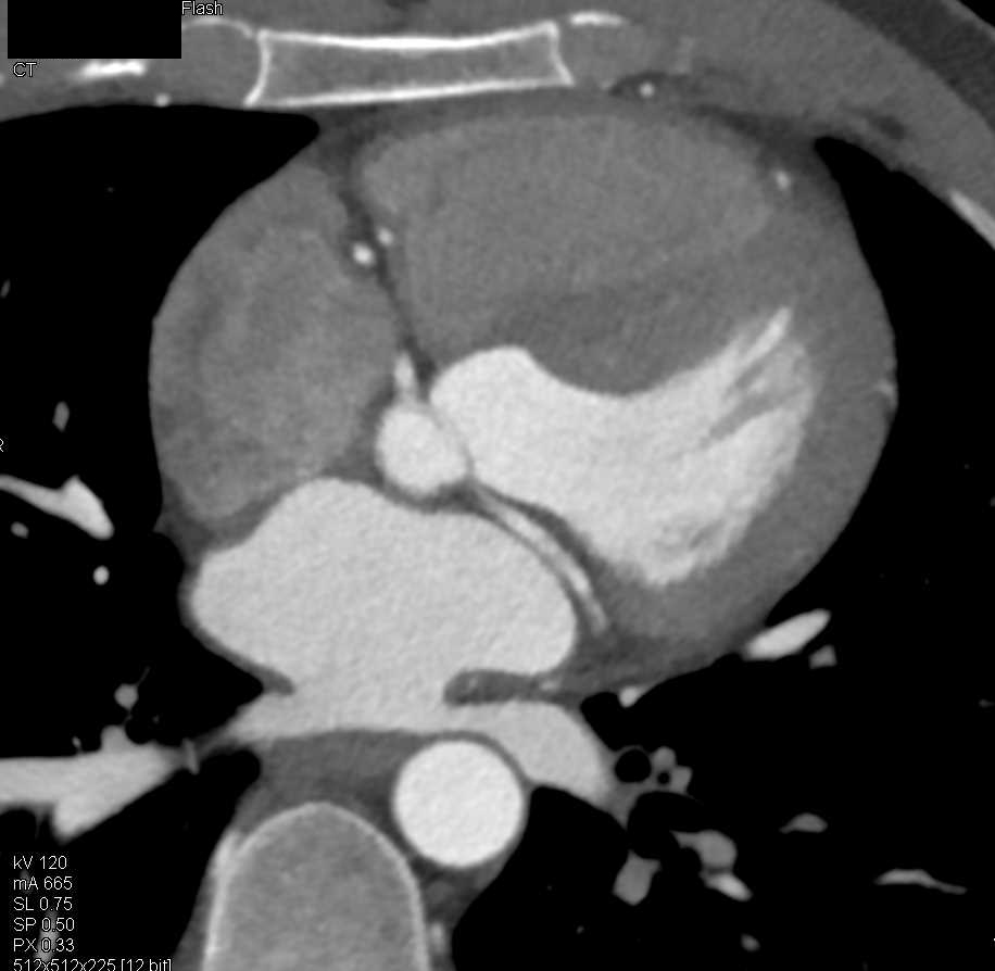 CCTA Normal Left Atrial Appendage Cardiac Case Studies CTisus CT
