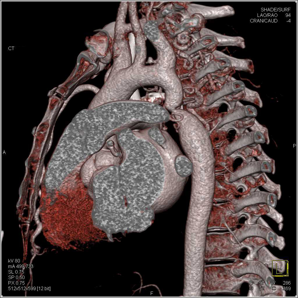 Coarctation of the Aorta and Bicuspid Aortic Valve Cardiac Case