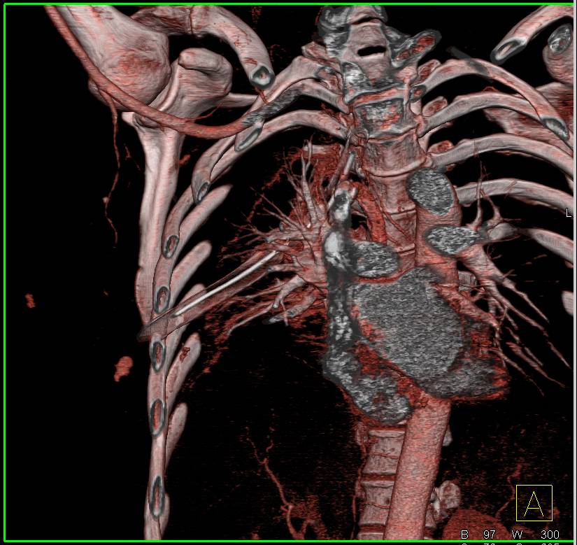 Trauma with Chest Wall Bleed and Pulmonary Hemorrhage Following Chest