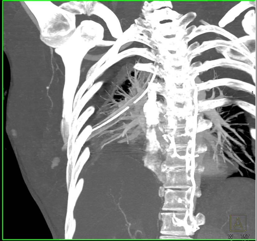 Trauma with Chest Wall Bleed and Pulmonary Hemorrhage Following Chest
