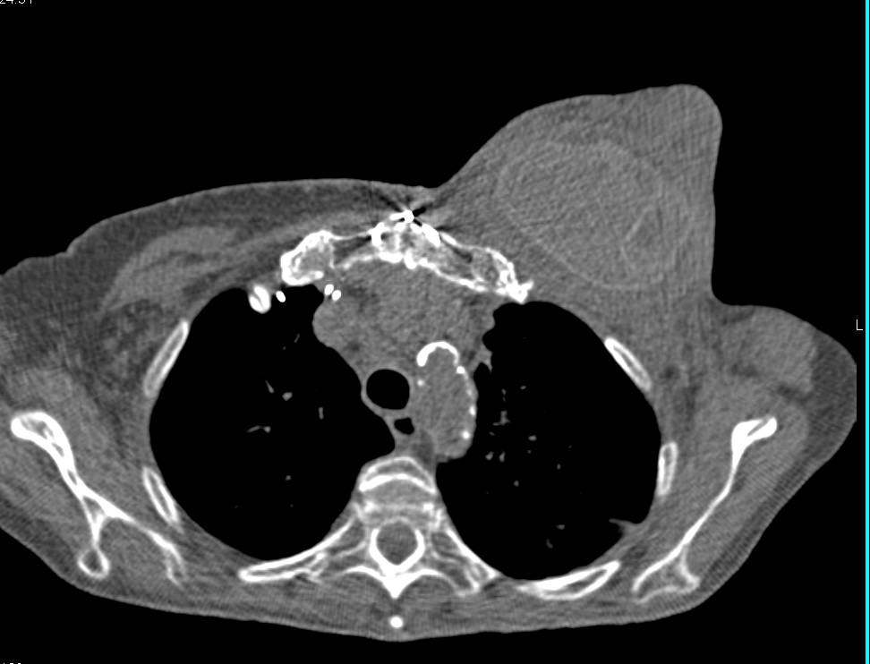 Failed Breast Prosthesis Chest Case Studies CTisus CT Scanning