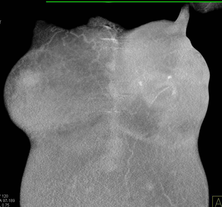 Failed Breast Prosthesis Chest Case Studies CTisus CT Scanning