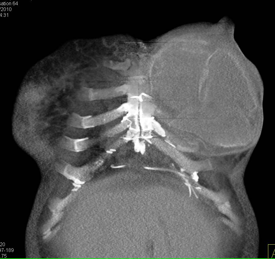Failed Breast Prosthesis Chest Case Studies CTisus CT Scanning