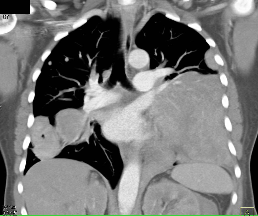 Lymphoma with Mediastinal, Lung Parenchymal and Renal Involvement