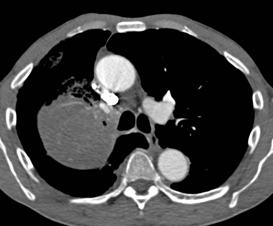 Lung Cancer (NSCLC) Encases the Right Upper Lobe Bronchus with Apical