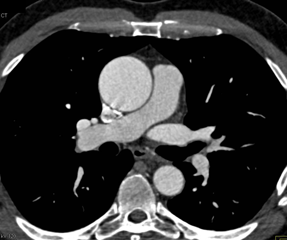 Dilated Aortic Root in Marfans Syndrome Chest Case Studies CTisus