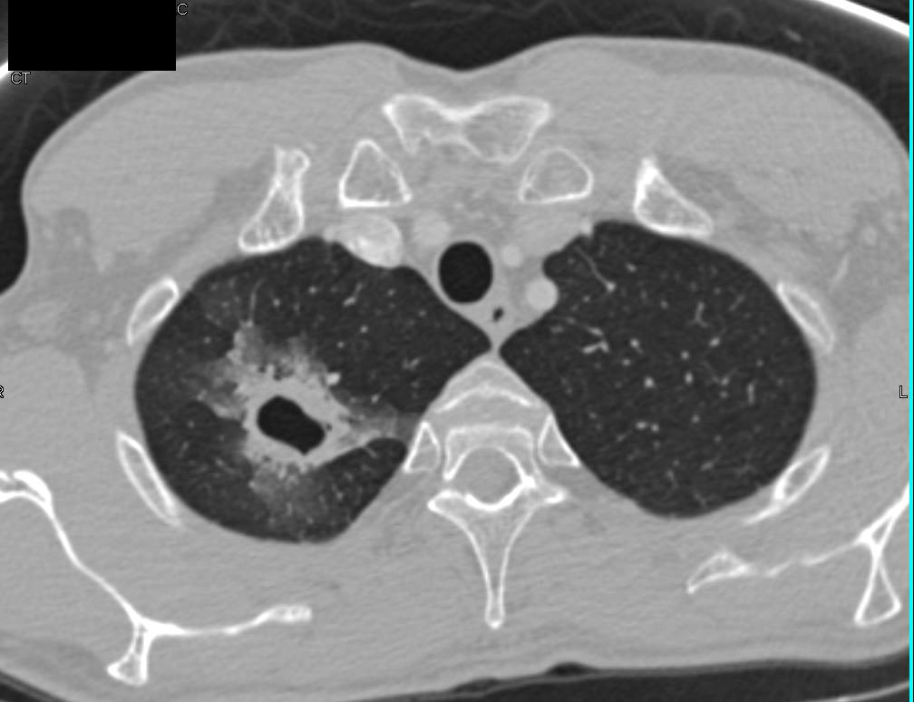 Cavitary Lesion due to Probable MAI Infection Chest Case Studies