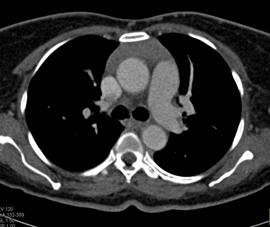 Normal Thymus for Age Chest Case Studies CTisus CT Scanning