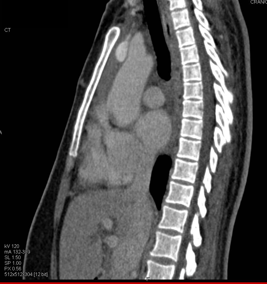 Normal Thymus for Age Chest Case Studies CTisus CT Scanning