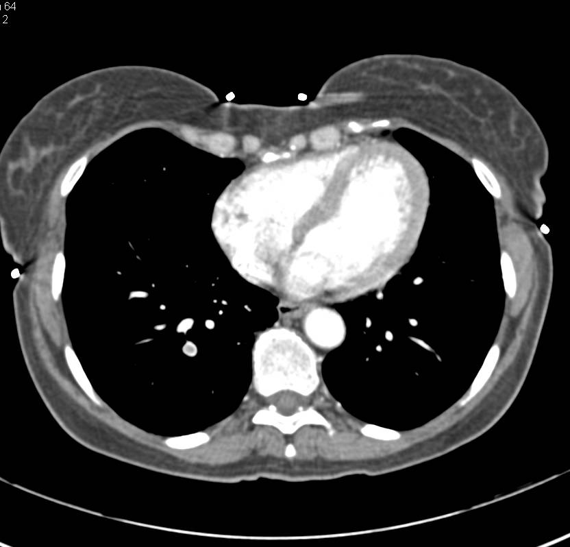 Pulmonary Embolism Right Lower Lobe Chest Case Studies