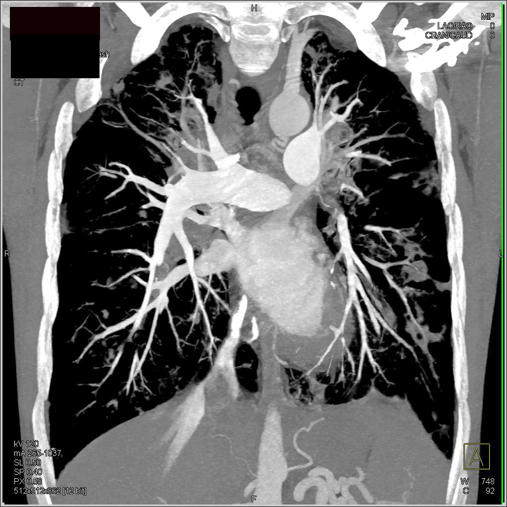 Cystic Fibrosis with Bronchiectasis Chest Case Studies CTisus CT