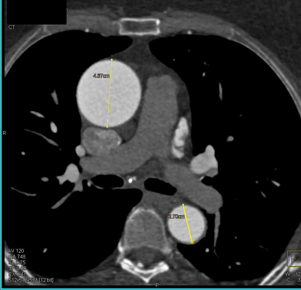 Dilated Ascending Aorta Chest Case Studies CTisus CT Scanning