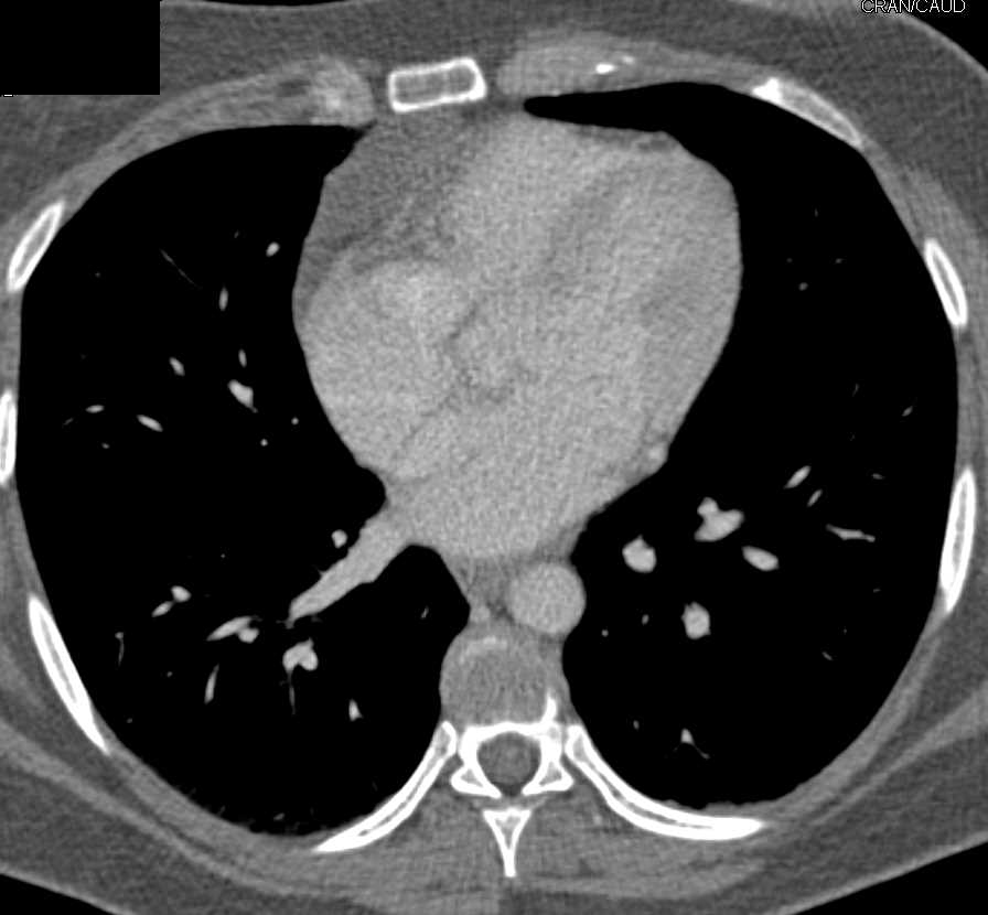 Thymic Hyperplasia Chest Case Studies CTisus CT Scanning