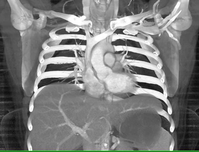 Fatty Infiltration of the Thymus Gland Chest Case Studies CTisus CT