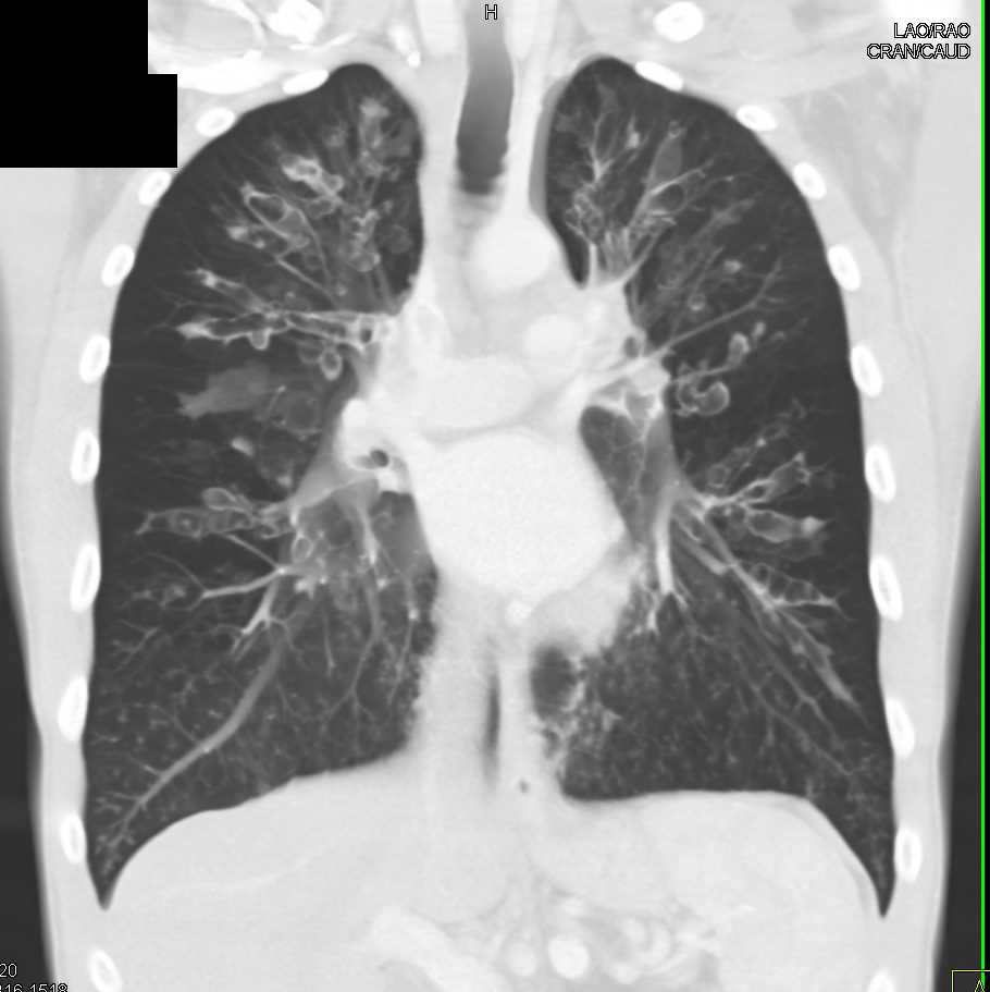 Cystic Bronchiectasis in Cystic Fibrosis Chest Case Studies CTisus