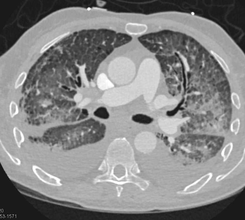 Pulmonary Edema in Patient with Interstitial Lung Disease