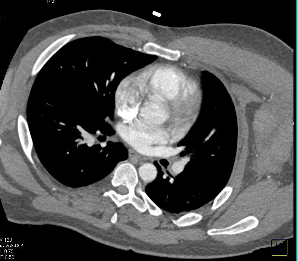 Hematoma Left Axillary Zone Chest Case Studies CTisus CT Scanning