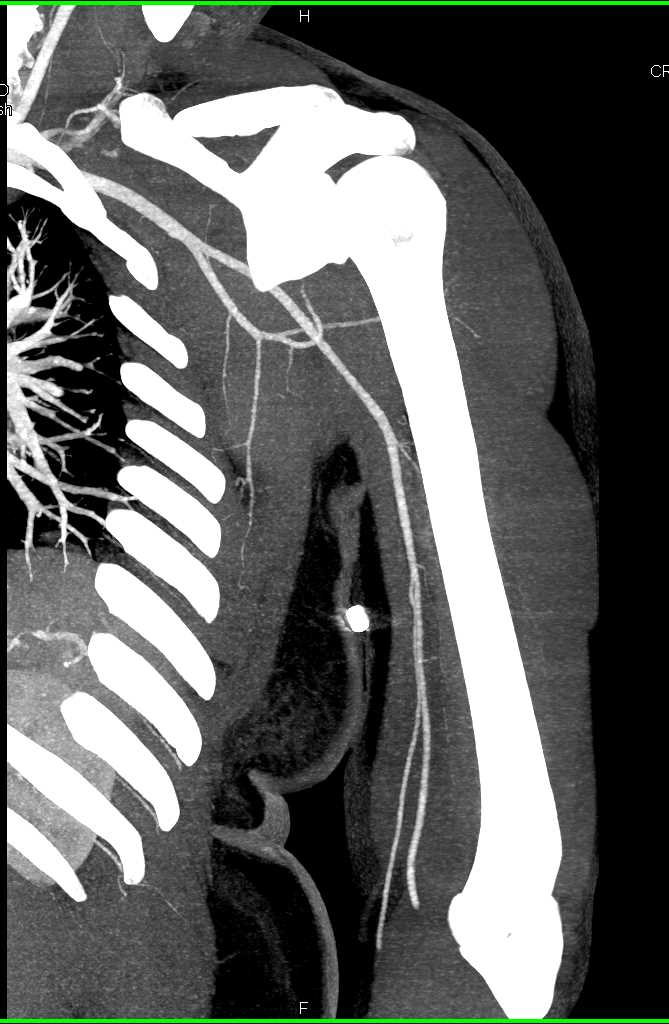 Hematoma Left Axillary Zone Chest Case Studies CTisus CT Scanning