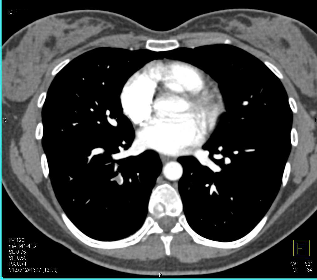 Pulmonary Embolism Chest Case Studies CTisus CT Scanning