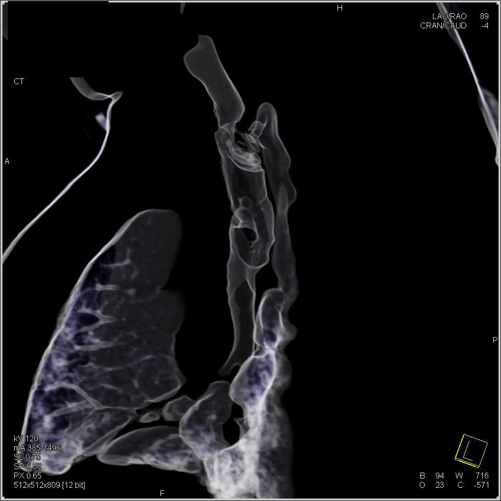 Stent in Trachea in 3D with Tracheal Stenosis Chest Case Studies