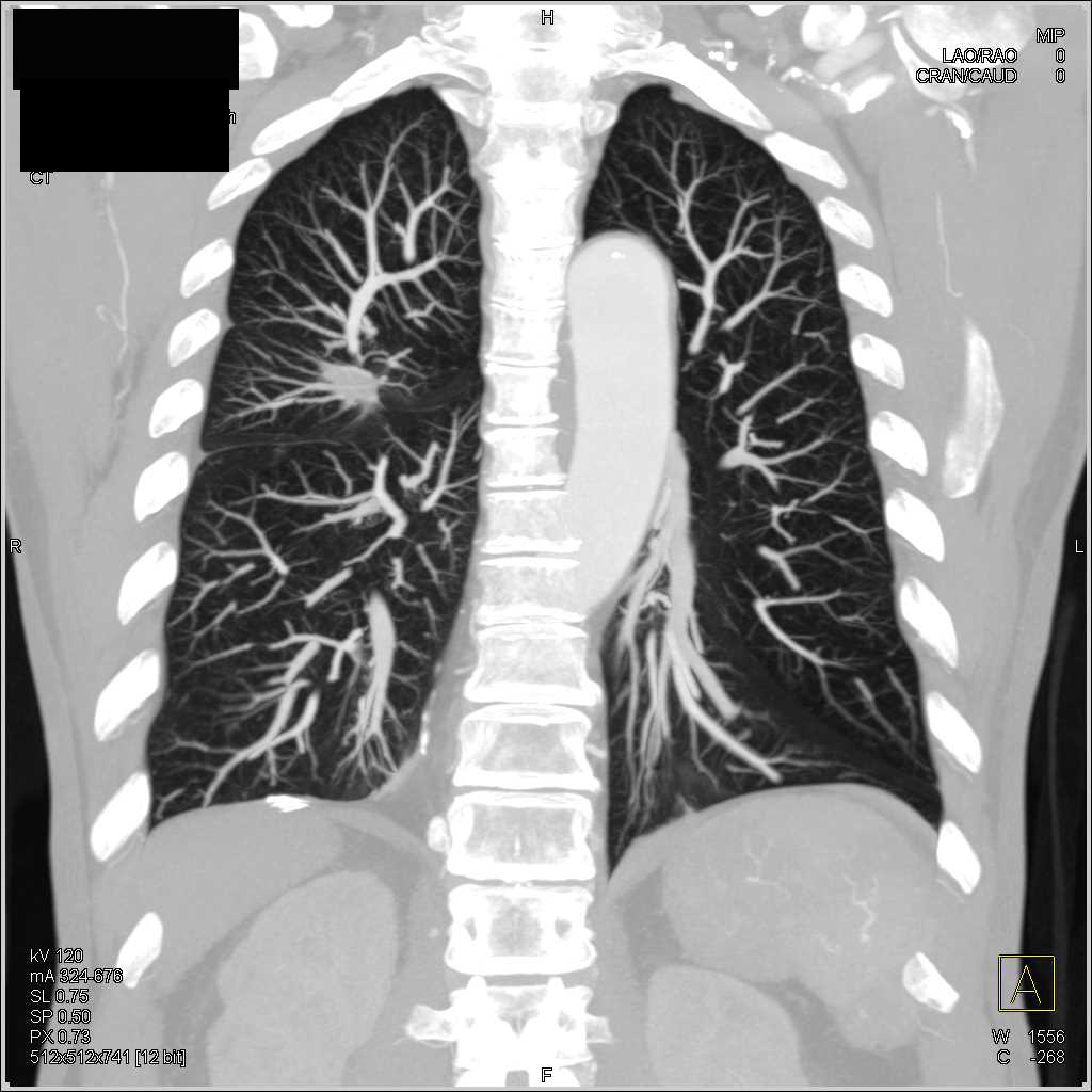 Incidental Scar Carcinoma Right Lung Chest Case Studies CTisus CT