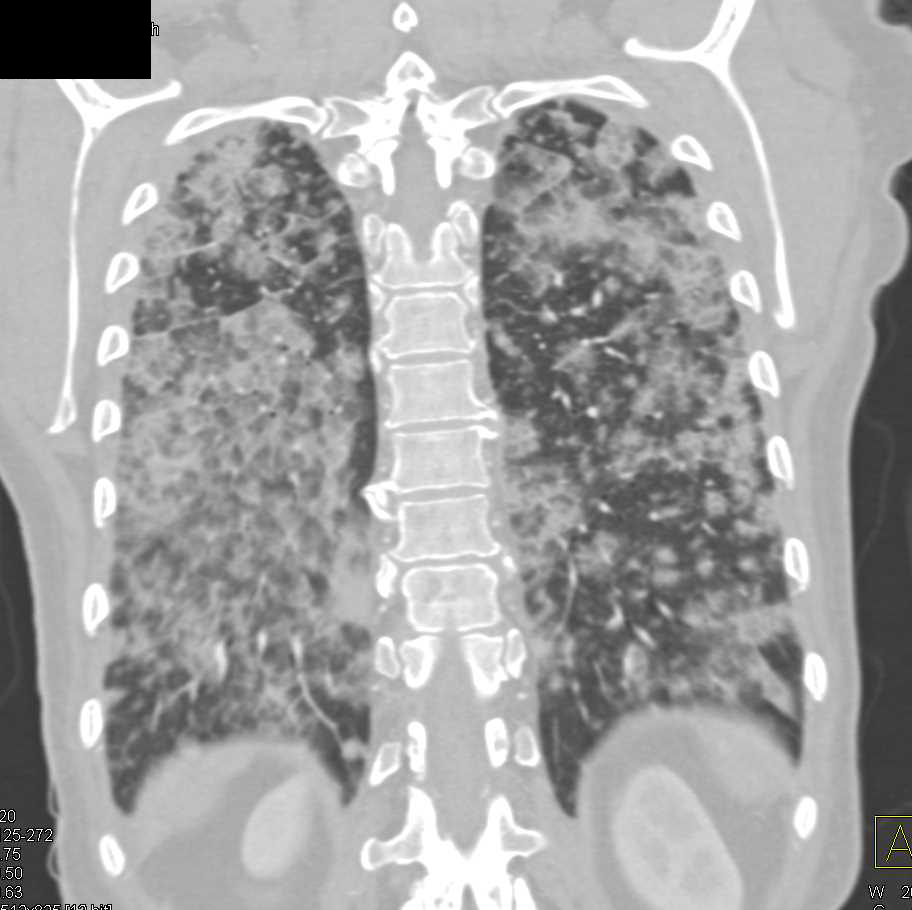 Diffuse Alveolar Infiltrates due to Hemorrhage Chest Case Studies