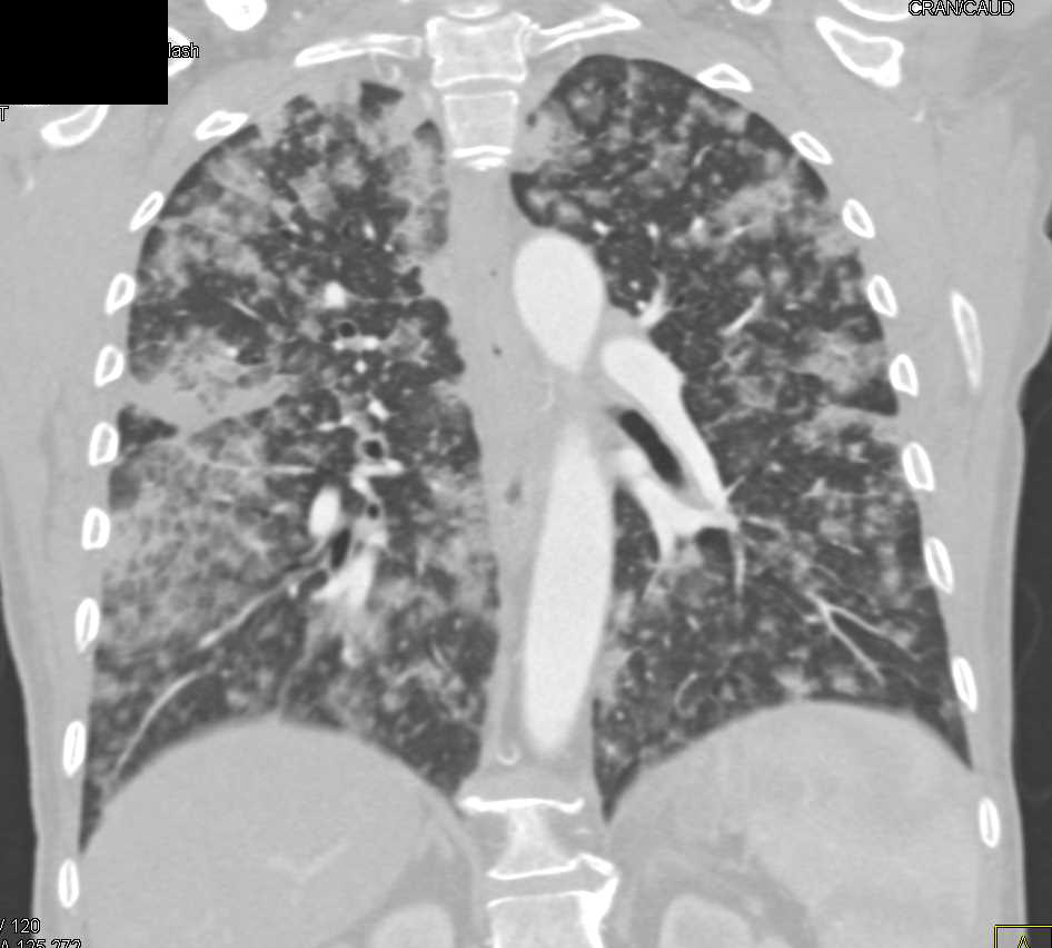 Diffuse Alveolar Infiltrates due to Hemorrhage Chest