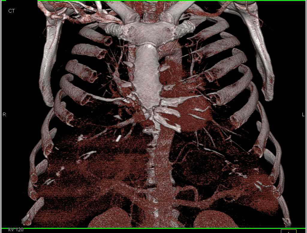 Infection in Right Chest Wall Chest Case Studies CTisus CT Scanning
