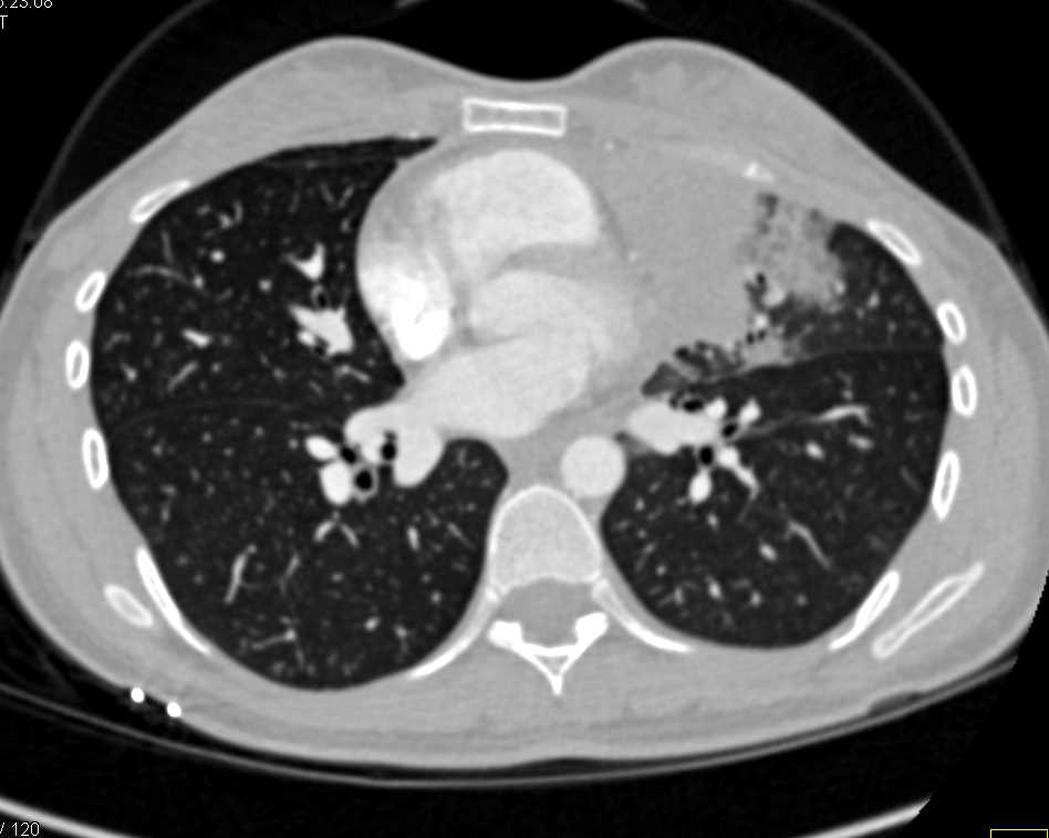 Lymphoma Involves the Chest Wall Chest Case Studies CTisus CT Scanning